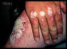 Qué dieta es buena para la psoriasis