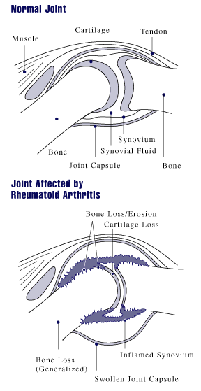 Dieta para la artritis reumatoidea