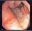 Gastritis ulcerosa