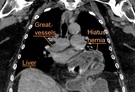 Hernia hiatal