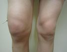 Rodilla inflamada